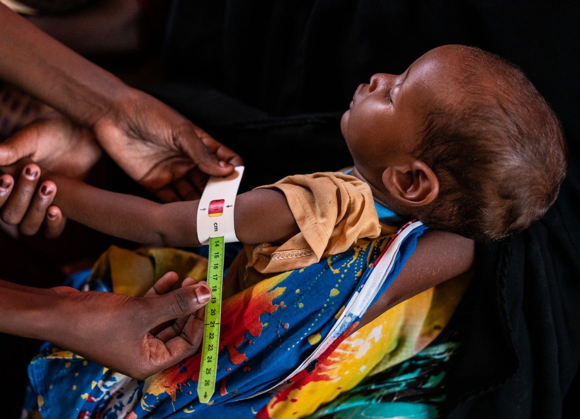 A health worker takes his MUAC reading, which shows nine-month-old Yasir is severely malnourished at Kabasa camp for internally displaced people in Dollow, Somalia