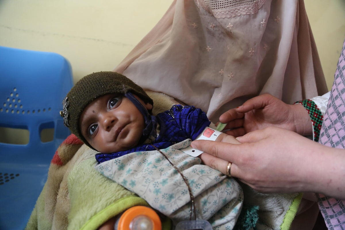 A baby assessed for malnutrition