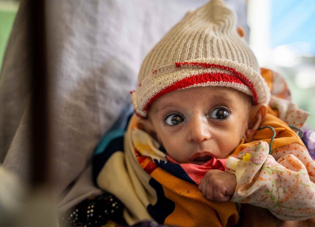 This severely malnourished baby is being treated at a children’s hospital in Kabul with support from UNICEF. 