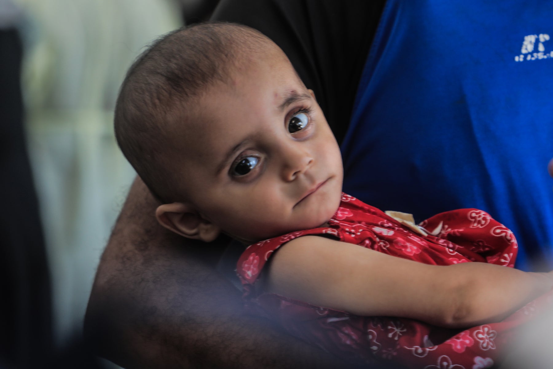 A father holds his young child who is suffering from malnutrition in Gaza.