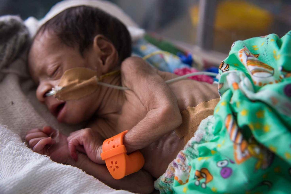 An underweight baby at the Special Care Nursery in Eastern Highlands Province with a hypothermia alert device, locally dubbed the Baby Kol Kilok, that helps signal an alert