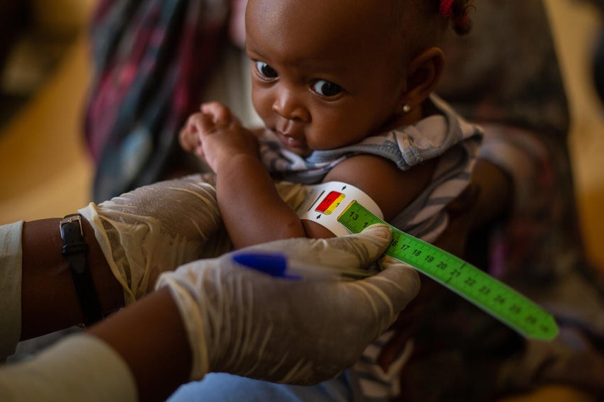 Areas in Sudan have witnessed a severe increase in malnutrition cases, especially among displaced children.
