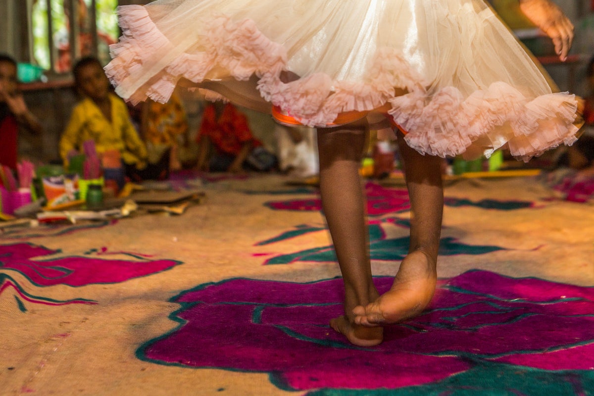 The image shows the legs of a girl. She is wearing a fluffy skirt, and looks like her foot has some condition.