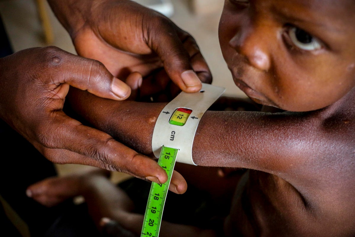A health worker measures a baby's upper arm to assess them for malnutrition.