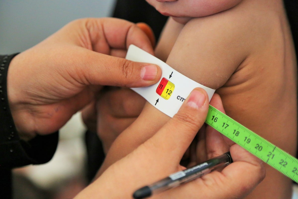 A girl in Yemen screened for malnutrition