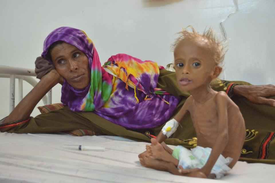 Severely malnourished Salim sits with his mother in bed in Yemen