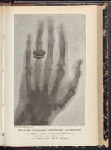 X-ray photograph of the hand of Albert von Kölliker, taken by Wilhelm Röntgen at a session of the Würzburg Society on Jan. 23, 1896, Sitzungs-Berichte der Physikalisch-medicinischen Gesellschaft zu Würzburg, 1896, no. 1, opp. p. 12 (Linda Hall Library)