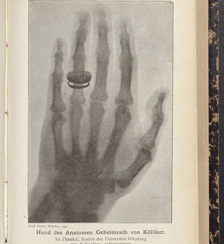 X-ray photograph of the hand of Albert von Kölliker, taken by Wilhelm Röntgen at a session of the Würzburg Society on Jan. 23, 1896, Sitzungs-Berichte der Physikalisch-medicinischen Gesellschaft zu Würzburg, 1896, no. 1, opp. p. 12 (Linda Hall Library)