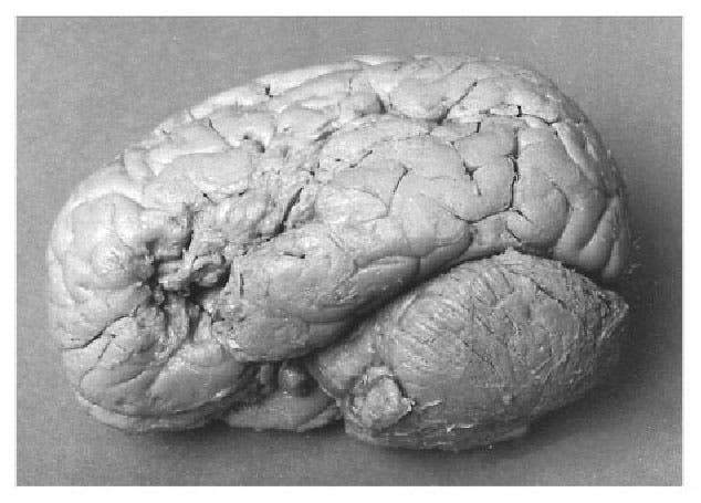 The left side of the brain of Leborgne, removed by Paul Broca in 1861, noting the lesion in the left frontal lobe, photograph, undated (semanticscholar.org)