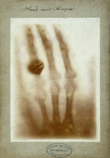 An X-ray photograph of the hand of Wilhelm Röntgen’s wife, Anna Bertha Ludwig, taken Dec. 22, 1895, and given by Röntgen to Professor Ludwig Zehnder of the Physik Institut, University of Freiburg, on Jan. 1, 1896 (Wikimedia commons)