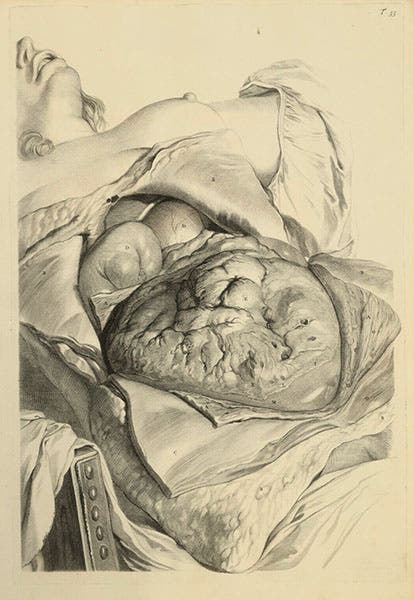 Abdomen of a female, engraved plate no. 55, after Gerard de Lairesse, in Govard Bidloo, Anatomia humani corporis, 1685 (odetowhitman on ebay.com)