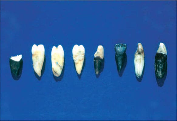 Stained teeth, found in a tin by Hinton’s executor after his death, photograph (onlinelibrary.wiley.com)