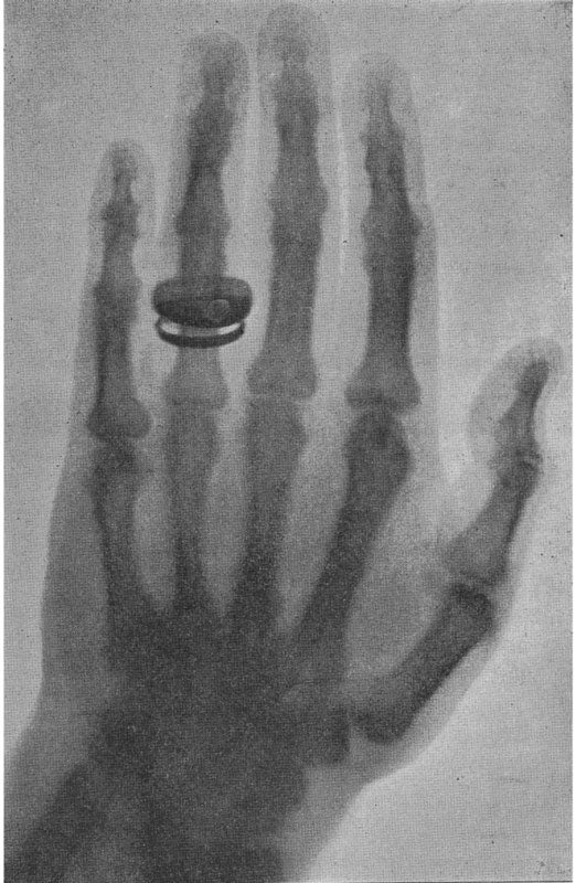 Roentgen's X-ray picture of the hand of Alfred von Kolliker from Sitzungsberichte der Wurzburger Physikalisch-Medicinischen Gesellschaft, November 1895.