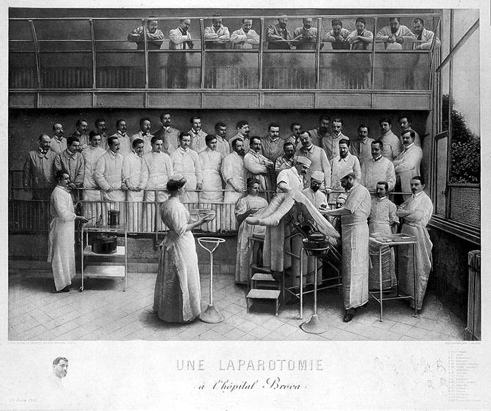Laparatomy operation, Hôpital Broca, heliogravure, 1901, Wellcome Collection, London (wellcomecollection.org)