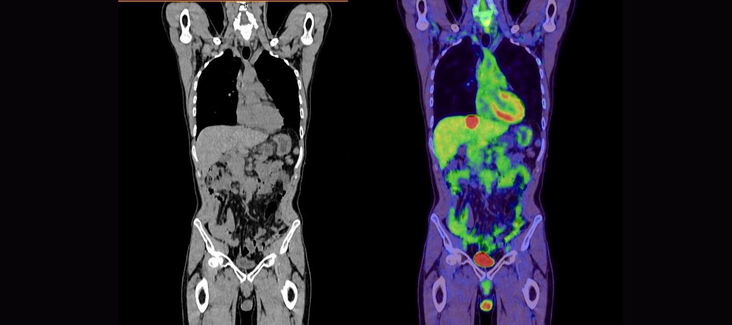 Image of Pet-ct scans