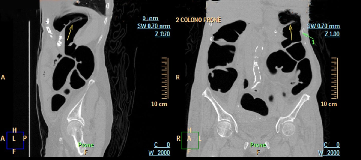 Colonography CT image of internal organs 