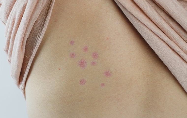 bed bug bites on skin